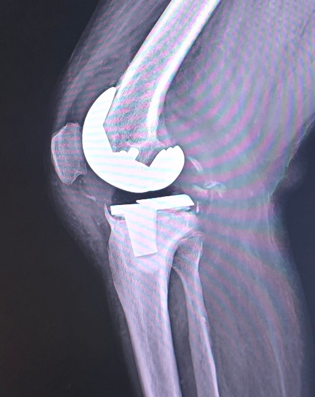 Before hip fracture fixation X-ray